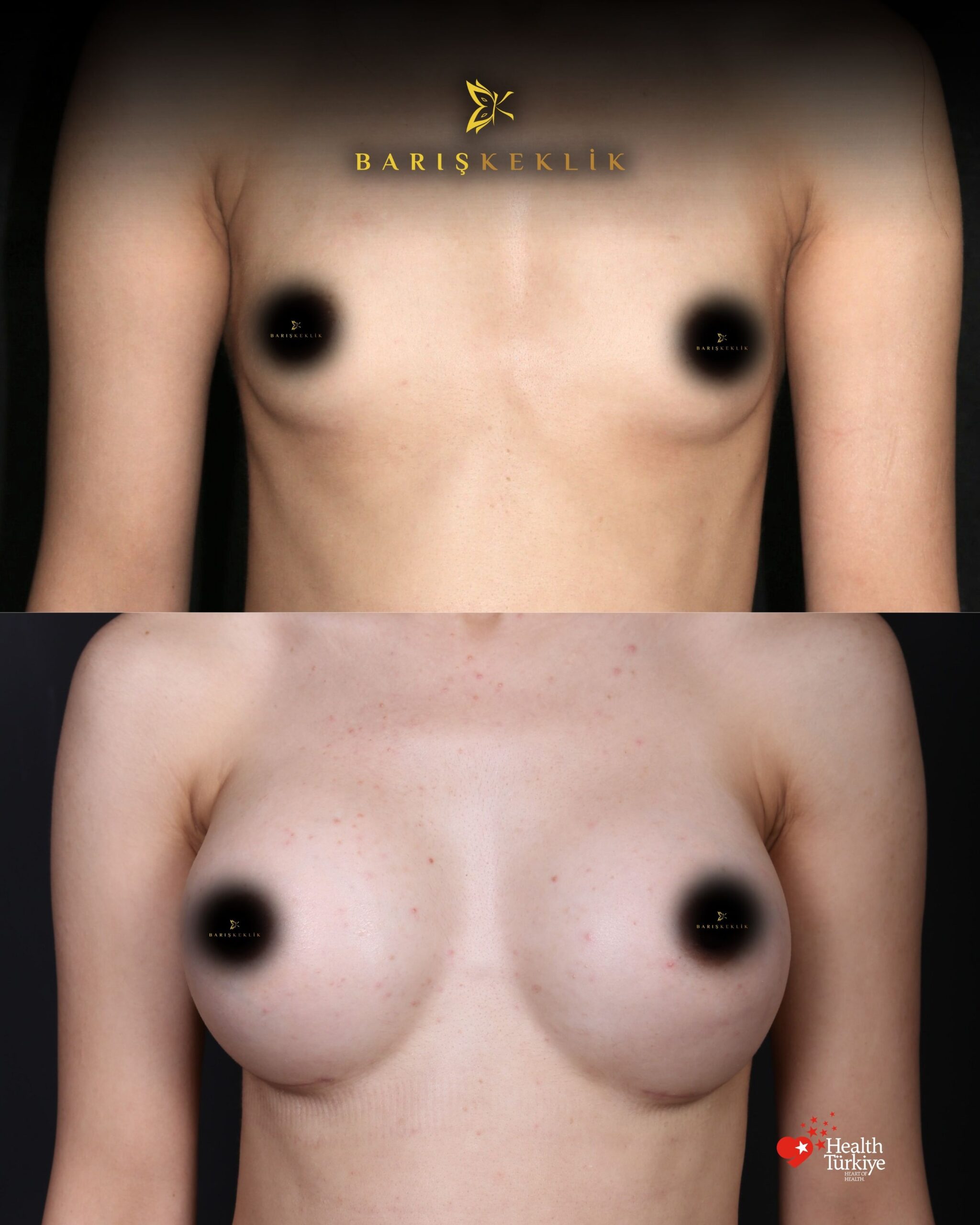 Breast Aesthetics in Turkey 23 2 scaled
