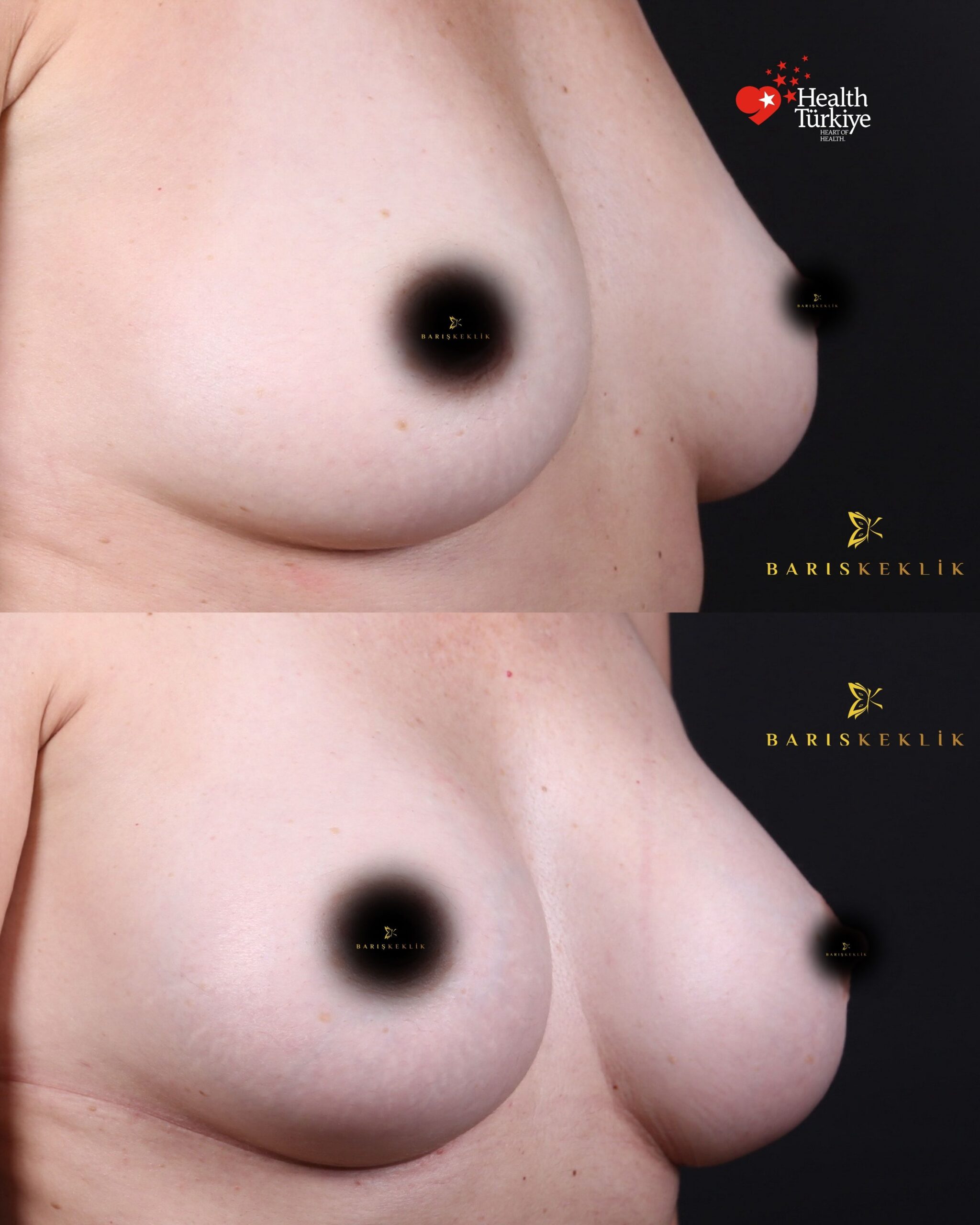 Breast Aesthetics in Turkey 22 26 scaled
