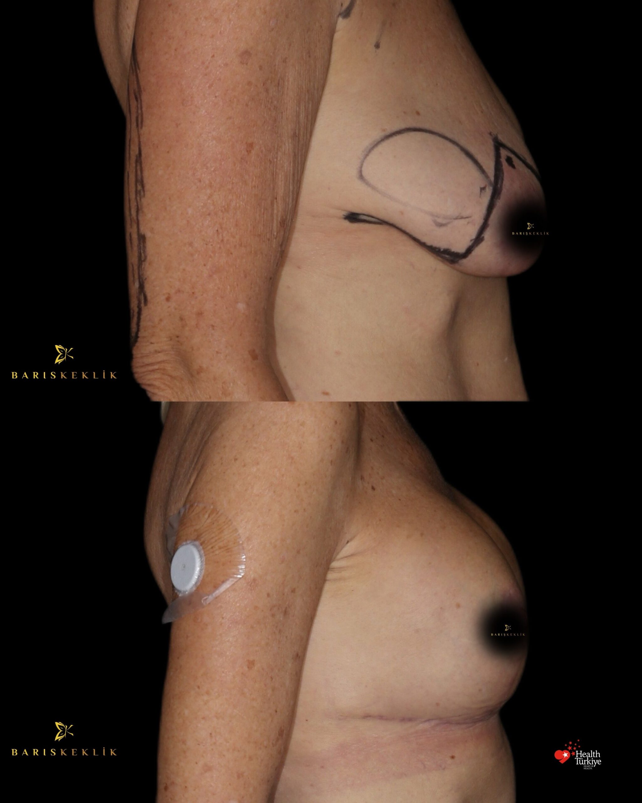 Breast Aesthetics in Turkey 21 51 scaled