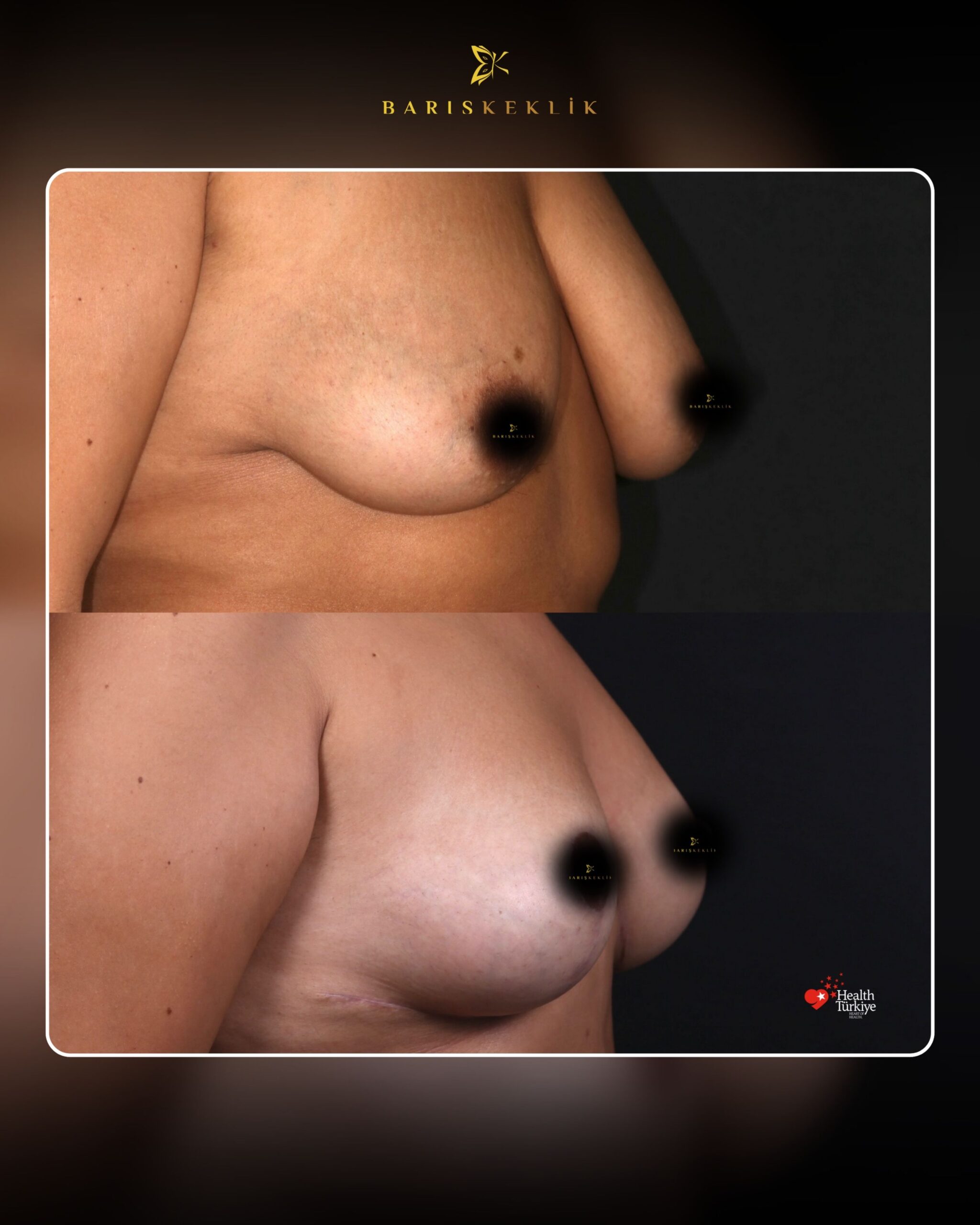 Breast Aesthetics in Turkey 19 97 scaled